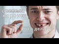 Чем ПРИКЛЕИТЬ временные коронки? Слетела КОРОНКА с зуба чем приклеить?