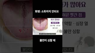 화병 불면증 불안증 역류성식도염 환자분의 혀갈라짐