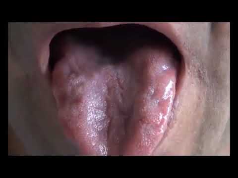 Tongue Fasciculations - YouTube Tongue Fasciculations - YouTube