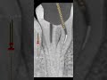 RCT Procedure with Broken Instrument Inside Root Canal | Step-by-Step Case🦷😲#shorts #viralshorts