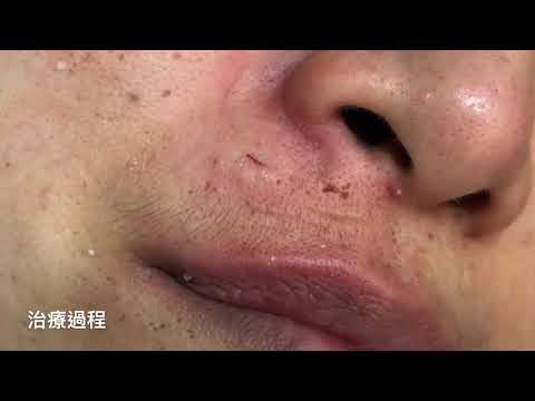 微創臉部/人中/鼻下粉瘤切除 傷口極小 美麗新城診所莊禮謙醫師 Minimal Incision, Epidermal Cyst, Philtrum, Dr George,