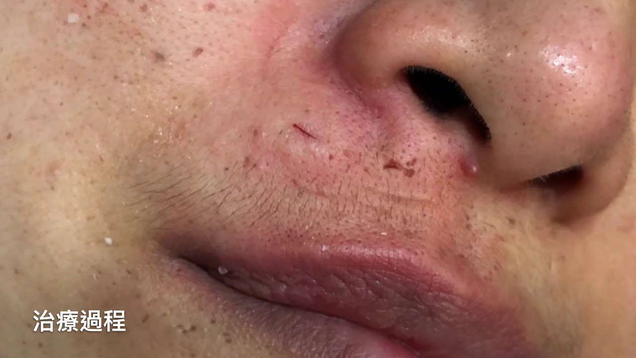 Minimal Incision, Epidermal Cyst, Philtrum, Dr George,