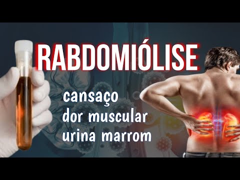 Vídeo: 3 maneiras simples de tratar rabdomiólise