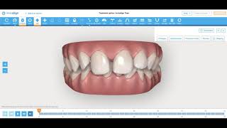 Invisalign Deep Bite and Diastema Correction: How I engineer tooth movement: Nirenblatt Orthodontics