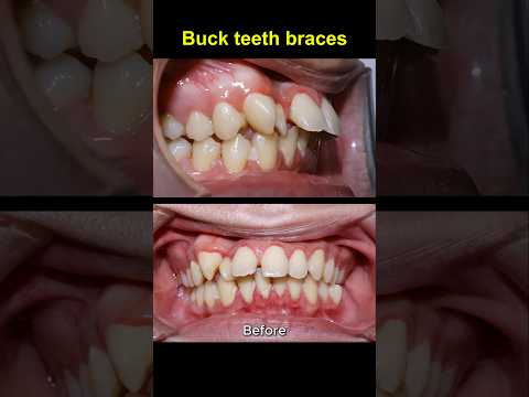 Buck teeth braces. 36 months duration braces dentist orthodontist by Nha Khoa Ocare