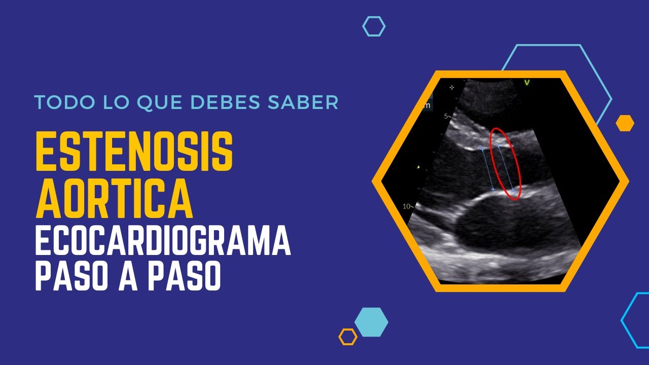 ✅ESTENOSIS AORTICA: Ecocardiograma Paso a Paso🚀