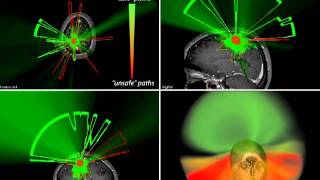 Crepuscular Rays for Tumor Accessibility Planning