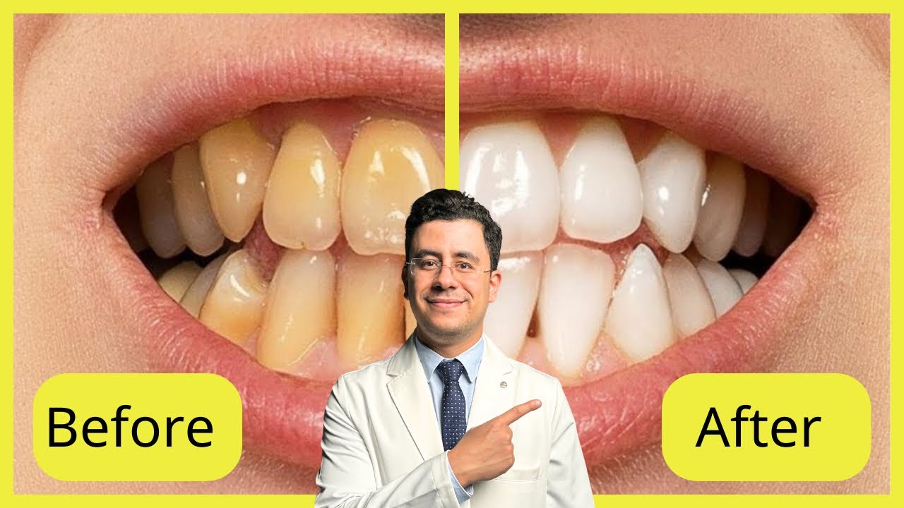 تبييض الاسنان فورا في المنزل