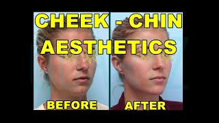 Cheek and Jawline Contour | Cheek and Chin Aestethics | Before and After | Leyla Arvas, MD