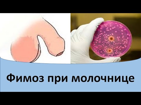 Фимоз при молочнице