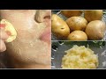 3  potato face pack           skin whitening remedy