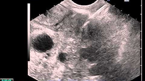 EUS guided Gold Fiducial marker placement for Cyberknife Radiotherapy