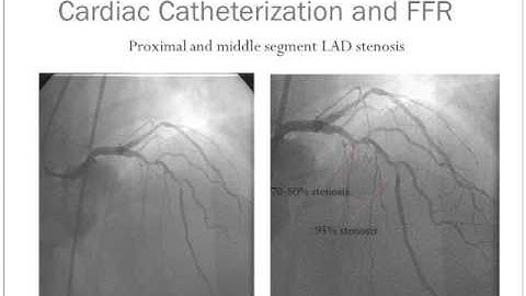 Using FFR to Assess Multivessel CAD in a Patient Refusing CABG