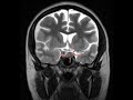 Pituitary adenoma causing left visual disturbance