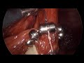 LINX Reflux Surgery Animation with Surgical Footage