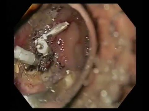 How to treat a bleeding duodenal ulcer (injection, coagulation, clipping)