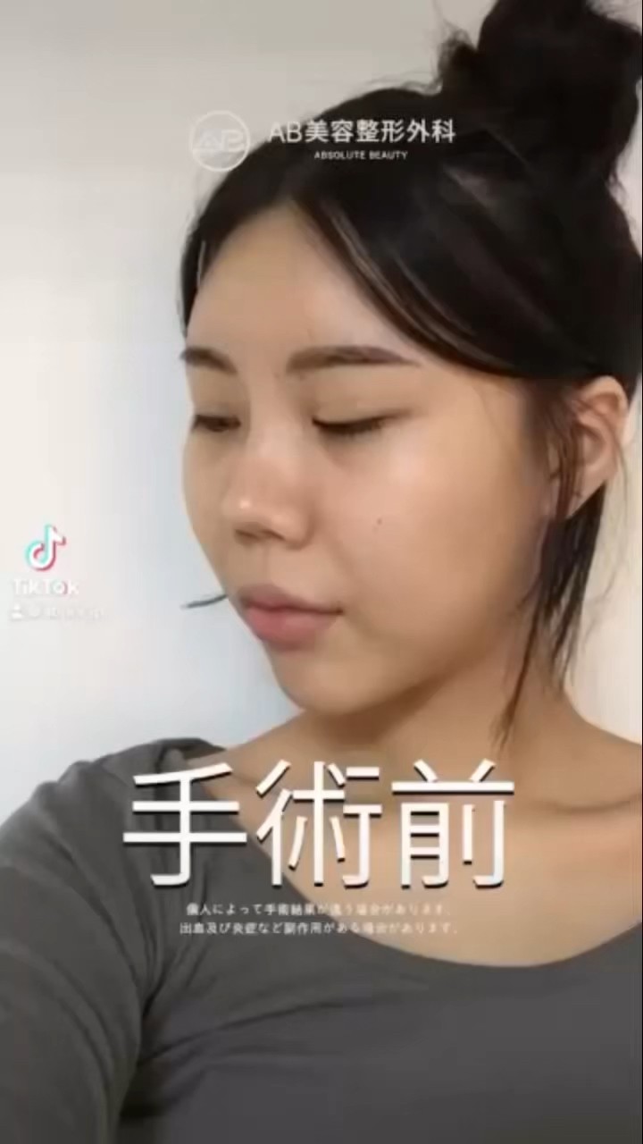 [韓国整形] 鼻の再手術 + 目尻切開 + 目下切開 + 目整形 #AB美容外科医院