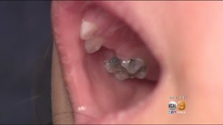 Children's Dental Center Again Ordered To Shut Down After Bacteria Found