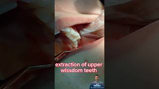 خلع ضرس العقل بدون ألم | اسرع خلع ضرس عقل|  no pain extraction upper wissdom teeth