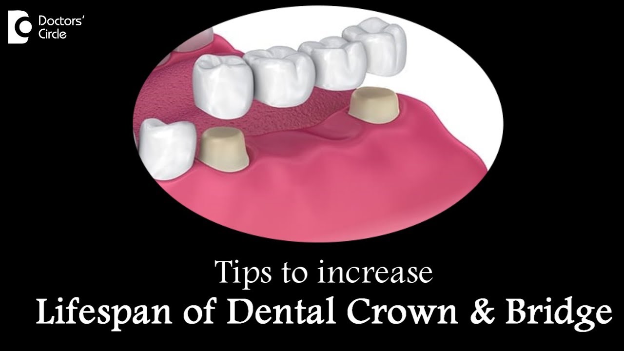 How to care for a crown and bridge? How long does it last? Dr