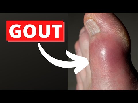 GOUT symptoms and treatment | 14 Lifestyle changes to CRUSH gout! | Doctor explains