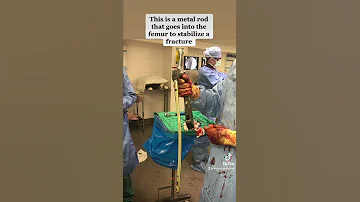 Femoral Intramedullary Nail 