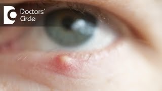 Are styes contagious? - Dr. Sriram Ramalingam