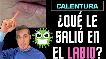 ¿Puede curarse el herpes labial en 3 días?