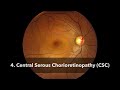 4. Central Serous Chorioretinopathy (CSC)