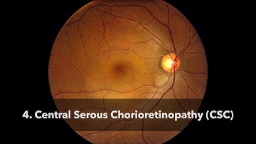 Central Serous Chorioretinopathy (CSC)