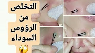 الرؤوس السوداء طريقتي لإزالتها و التخلص منها + ماسك للبشرة بعد عملية النزع 