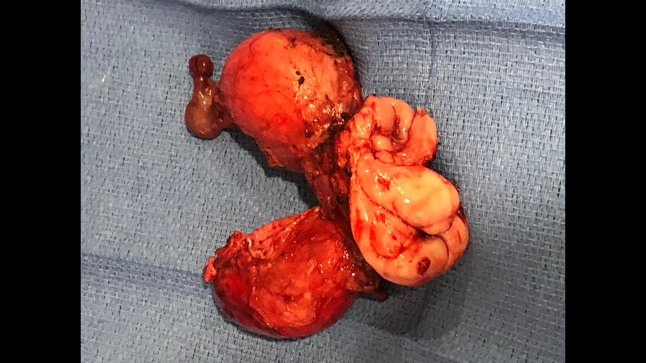 New Surgical Video - Hysterectomy with Uterine Didelphys