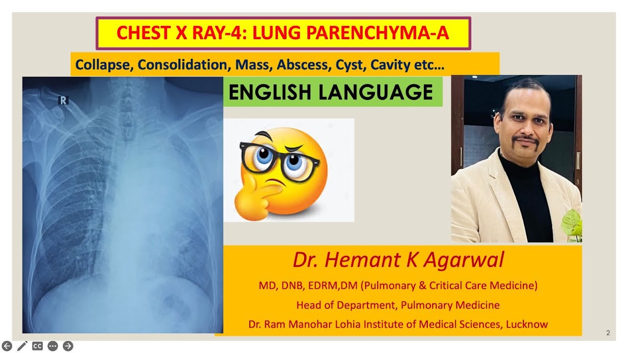 Radiology- Chest X Ray:4, (ENGLISH) Collapse, Consolidation, Mass, Abscess...@Dr. Hemant K Agarwal