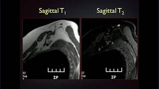 MRI of the Brachial Plexus screenshot 4