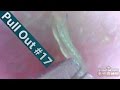 #17 Pull Out Blackheads Close up - Blackheads Removal