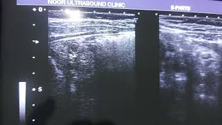 Retrocecal appendix..Acute appendicitis on ultrasound