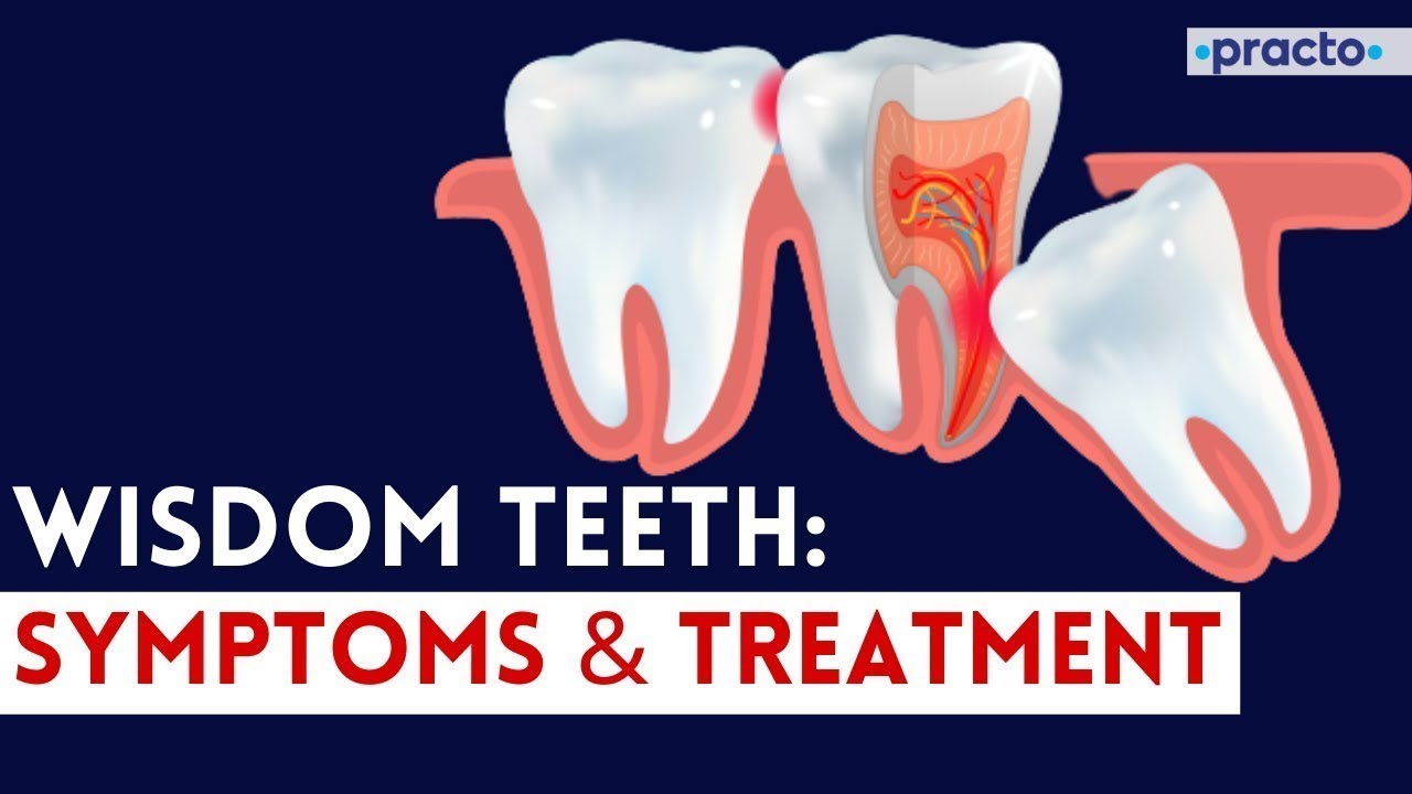 Wisdom Tooth EXPLAINED (Pain, Symptoms, Treatment options & Prevention