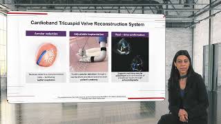 Transcatheter Trilogy Part 3: Edwards’ portfolio of tricuspid treatment options | Presentation