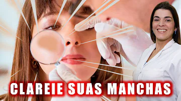 O que pode causar melasma no rosto?
