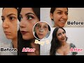 Rhinoplasty Vlog *Life Changing* (Surgery + Recovery + Nose Reveal) // Tips & Tricks!!!