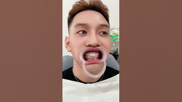 Nhân viên của chủ tịch đi làm răng sứ công nghệ cũ ở quê bị ố vàng và cái kết... #shorts