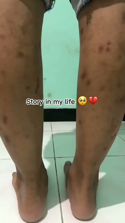 Akhirnya Mulus.. Pejuang  Bekas Koreng !! #skincareviral