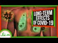 From Scarred Lungs to Diabetes: How COVID May Stick With People Long-Term | SciShow News