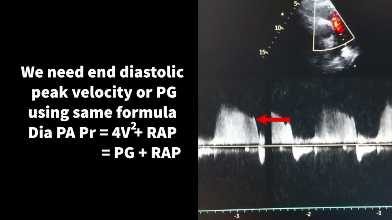 How To Estimate Pulmonary Artery Pressure On Echo YouTube How To Estimate Pulmonary Artery Pressure On Echo YouTube