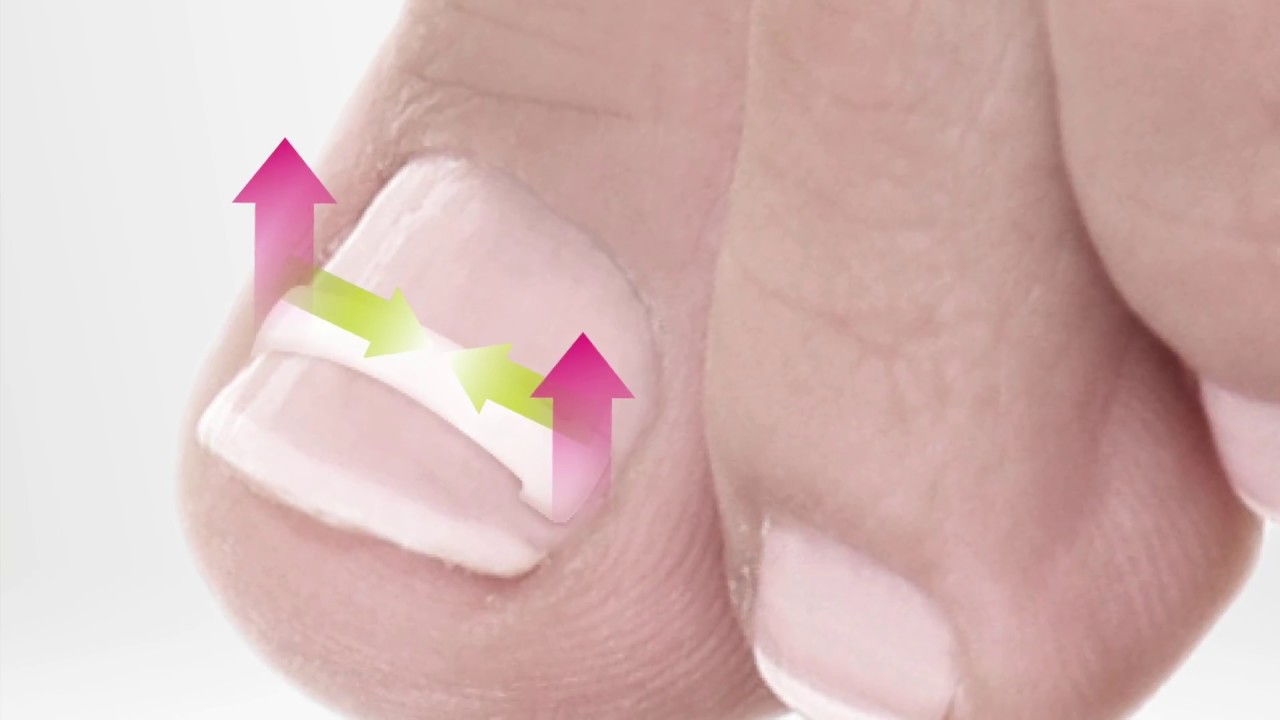 NEW СИСТЕМА КОРРЕКЦИИ ВРОСШЕГО НОГТЯ PODOSTRIPE от компании 3TO - YouTube