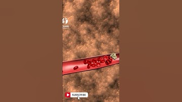 Visualizing Ischemic Stroke : Animation Guide to Brain Blockages 🧠
