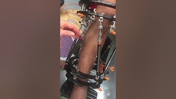 Taylor Spatial Frame turns