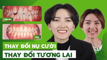 Kết Quả Sau Gần 2 Năm Niềng Răng Với Nhiều "Mồ Hôi Và Nước Mắt"