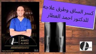 كسر الساق - الاسباب وطرق العلاج للدكتور احمد العطار