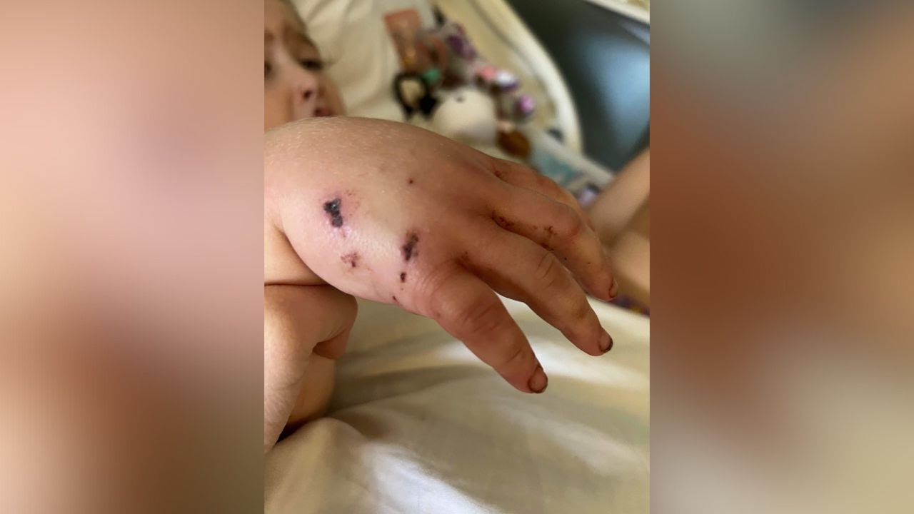 Girl recovering after bobcat attack in Oglethorpe County YouTube